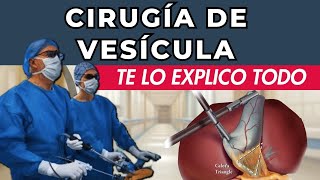 CIRUGÍA DE VESÍCULA  Colecistectomía Laparoscópica  Lo que debes saber [upl. by Irvin]