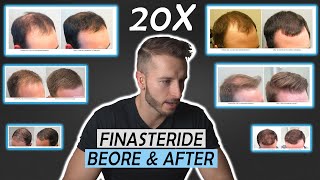 20 Finasteride Before And After Results NW1  NW5NW6 [upl. by Muhammad]