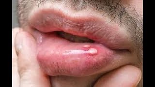 Early Signs of HIV in Men What Symptoms Should You Look out For [upl. by Naynek]