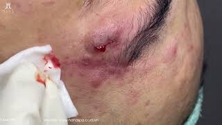 Big Cystic Acne Blackheads Extraction Blackheads amp Milia Whiteheads Removal Pimple Popping [upl. by Yunfei141]