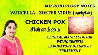 VaricellaZoster virus  chicken pox Shingles  Pathogenesis  Lab diagnosis  Treatment  Tamil [upl. by Greene]