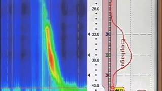 esophageal manometry [upl. by Reiche238]