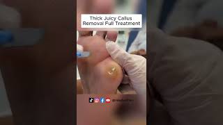 Ultimate Callus Removal Full Treatment For Smooth Feet  FootClinicLondoncouk [upl. by Animar]