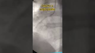 Angioplastia coronaria en el Infarto [upl. by Eniawd]