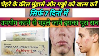 Aziderm 10 Cream Review  How to use  Aziderm 10 For Pimple and Acne Scars amp pigmentation malasma [upl. by Sitruk126]