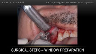 Lateral window direct sinus lift  Trap door technique using Dentium Advanced Sinus Kit  DASK [upl. by Labaw]