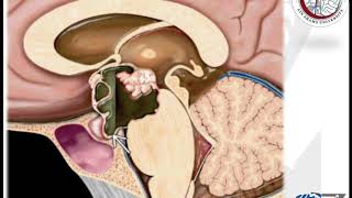 Brain Tumours 48 Craniopharyngioma 1 الورم القحفي البلعومي [upl. by Kimber]