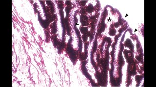 Cyclophotocoagulation Part II Endocyclophotocoagulation Malik Y Kahook MD [upl. by Arem]