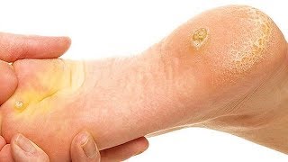 How to Get Rid of Calluses on Feet Overnight [upl. by Carver]