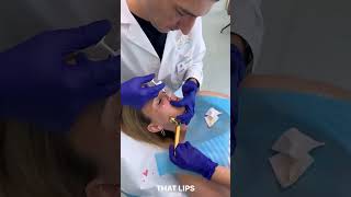 Lips Filler Treatment in Dubai  Natural amp Plump Results [upl. by Ofella]