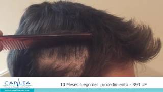 Alopecia cicatrizal paciente tratado en Capilea [upl. by Yehsa327]