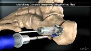 Medializing Calcaneal Osteotomy [upl. by Norma135]