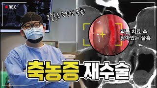 축농증 재수술 코리아 이비인후과 revision ESS endoscopic sinus surgery [upl. by Ardnuahc496]