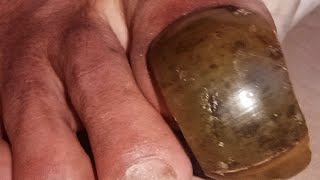 Extreme Toenail Transformation Cutting Wild amp Smelly Toenails [upl. by Irok]