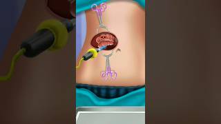 asmr surgery  asmr colonic polyps  asmr separators  asmr laser treatment  shortvideo asmr [upl. by Irot]