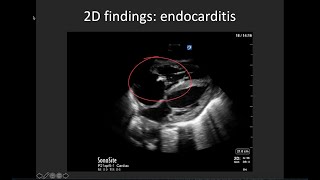 Basic Valve Evaluation with POCUS [upl. by Winnifred]