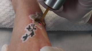 PicoWay Tattoo Removal [upl. by Darnok]