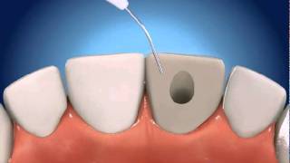 Scaling and Root Planing Part II Mandibular Teeth [upl. by Julee]