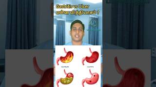 அல்சர் இரைப்பை அழற்சி என்ன வித்தியாசம்Gastritis vs Ulcer differencePangastritisulcer gastritis [upl. by Edmund12]