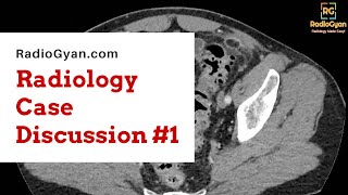 Acute Epiploic Appendagitis  Radiology Board Review Case [upl. by Bensen]