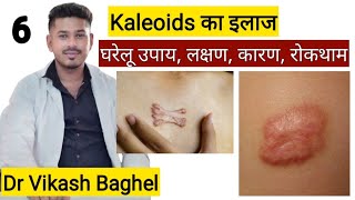 Keloid ka gharelu upchar  Keloid ka ilaj in hindi  Keloid kaise khatam kare  Ayurveda amp Medicine [upl. by Sible676]