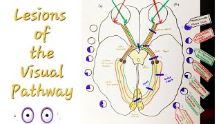 Lesions of the Visual Pathway  Optic Nerve and pathway lesions [upl. by Eerual308]