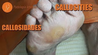 Callos y callosidades  1er video podología asmr [upl. by Enajiram191]