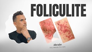 FOLICULITE O que é Quais pomadas indicadas Tratamento Medicamento [upl. by Kristo244]