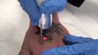 QSwitched NdYAG Tattoo Removal Laser  The Astanza Duality [upl. by Corso]