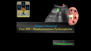 Ultrasound Case 296  Emphysematous Pyelonephritis [upl. by Nodnorb]