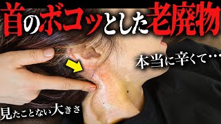 【超巨大】老廃物でパンパンに膨れ上がった首に激痛整体をしたら…驚きの変化に思わず… [upl. by Calendra]