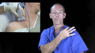 Supraclavicular nerve block ultrasound guided [upl. by Hairas]