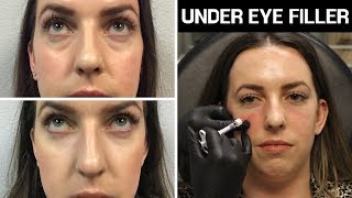 All About Under Eye Filler 💉 Restylane amp Restylane Lyft Before amp After Photos Does It Work Cost [upl. by Willms]