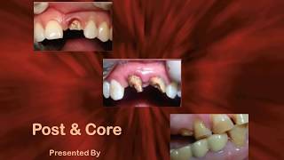 Post amp Core Upgrade Dentistry Webinar Dr Harpreet Singh  Part 1 [upl. by Ellwood]