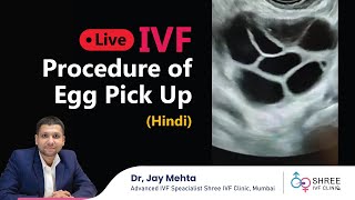 LIVE IVF Procedure of Egg Pick Up Hindi  Oocyte Retrieval  Dr Jay Mehta Mumbai  IVF in Hindi [upl. by Ebocaj259]