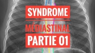 Syndrome Médiastinal  partie 01 [upl. by Notyep465]