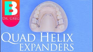 Quad Helix Expander for Braces  Invisalign [upl. by Thorvald]