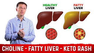 Choline One of The Best Vitamins for Fatty Liver – Dr Berg [upl. by Burkhard586]