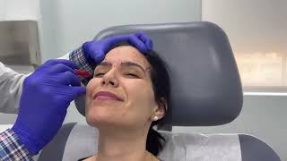 Nonsurgical face lifting using the temporal lift technique and Restylane filler  Dr Patel in Miami [upl. by Tait]