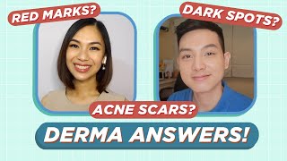 SKIN How to Get Rid of Dark Scars Hyperpigmentation amp Acne Scars at Home No Click Bait [upl. by Mccoy]