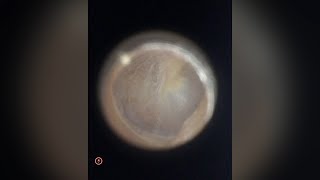 Otoscopy of Dehiscence of the Tegmen Tympani [upl. by Olimac985]