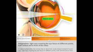 Astigmatism by Quantel Medical [upl. by Nohtanoj]