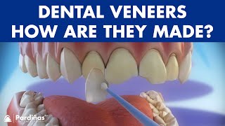 Veneers  How are they made Preparation and placement of cosmetic dentistry veneers © [upl. by Marmion292]