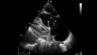 PULMONARY EMBOLISM  EMBOLIE PULMONAIRE  ECHOCARDIOGRAPHY cardiac ultrasound [upl. by Roarke]