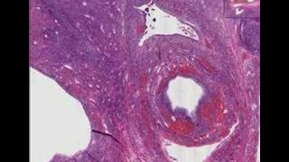 Histopathology Ovary Polycystic ovarian disease SteinLev [upl. by Purity]