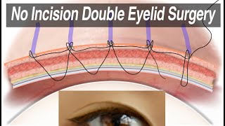 NonIncisional Asian Double Eyelid Surgery Suture Technique for Monolid Correction Animation [upl. by Aiam]