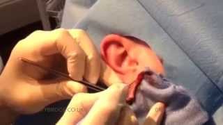 Tribal ear tunnel correction [upl. by Halie]