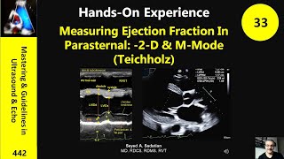 Measuring Ejection Fraction In Parasternal 2D amp MMode Teichholz [upl. by Hsirap]