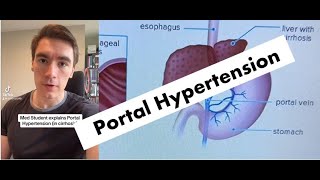 COMPLICATIONS of Portal Hypertension EXPLAINED [upl. by Benedix]