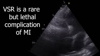 Cardiogenic shock due to VSR [upl. by Portia]